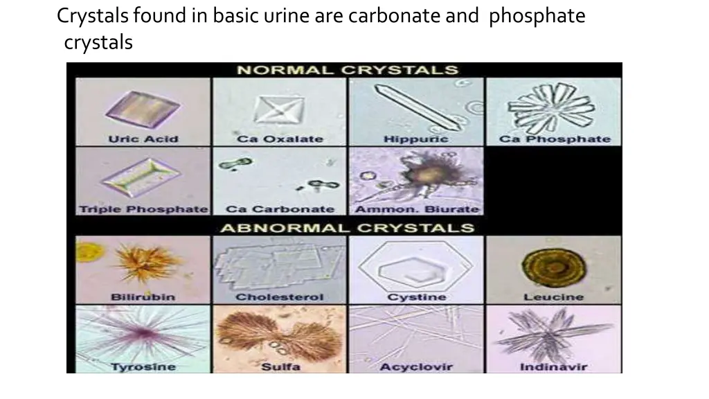 crystals found in basic urine are carbonate
