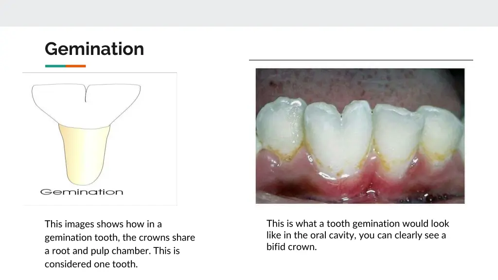 gemination 1
