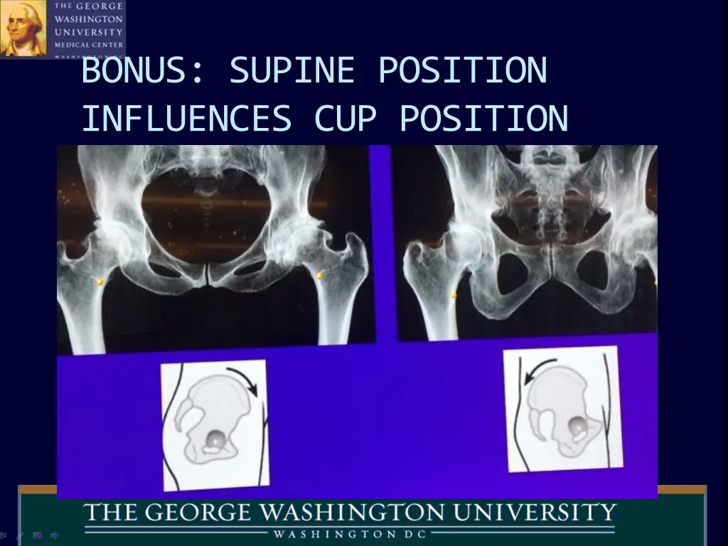 bonus supine position influences cup position