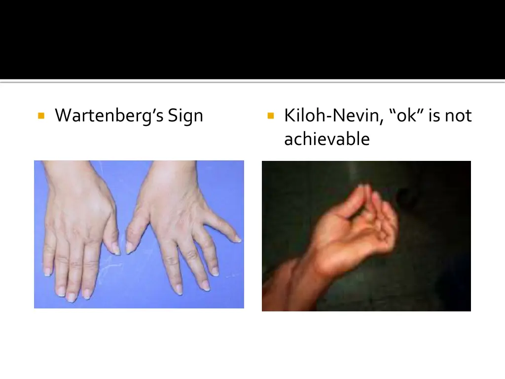 wartenberg s sign