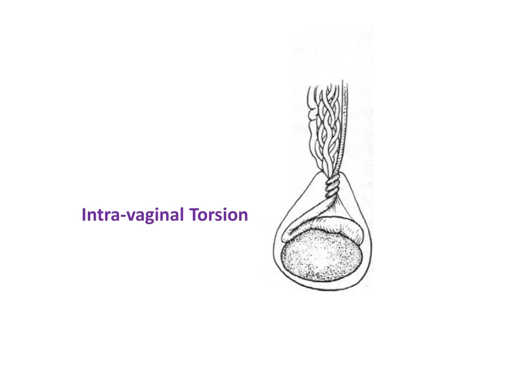 intra vaginal torsion