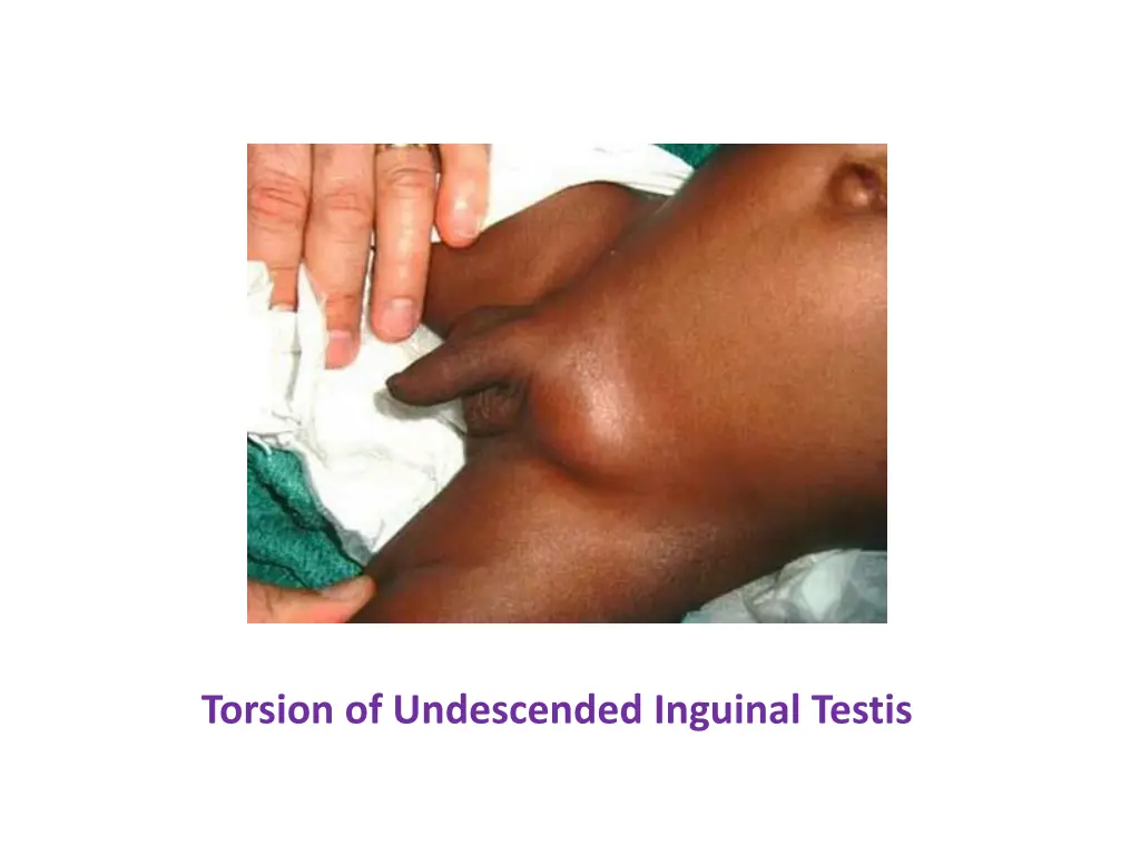 torsion of undescended inguinal testis