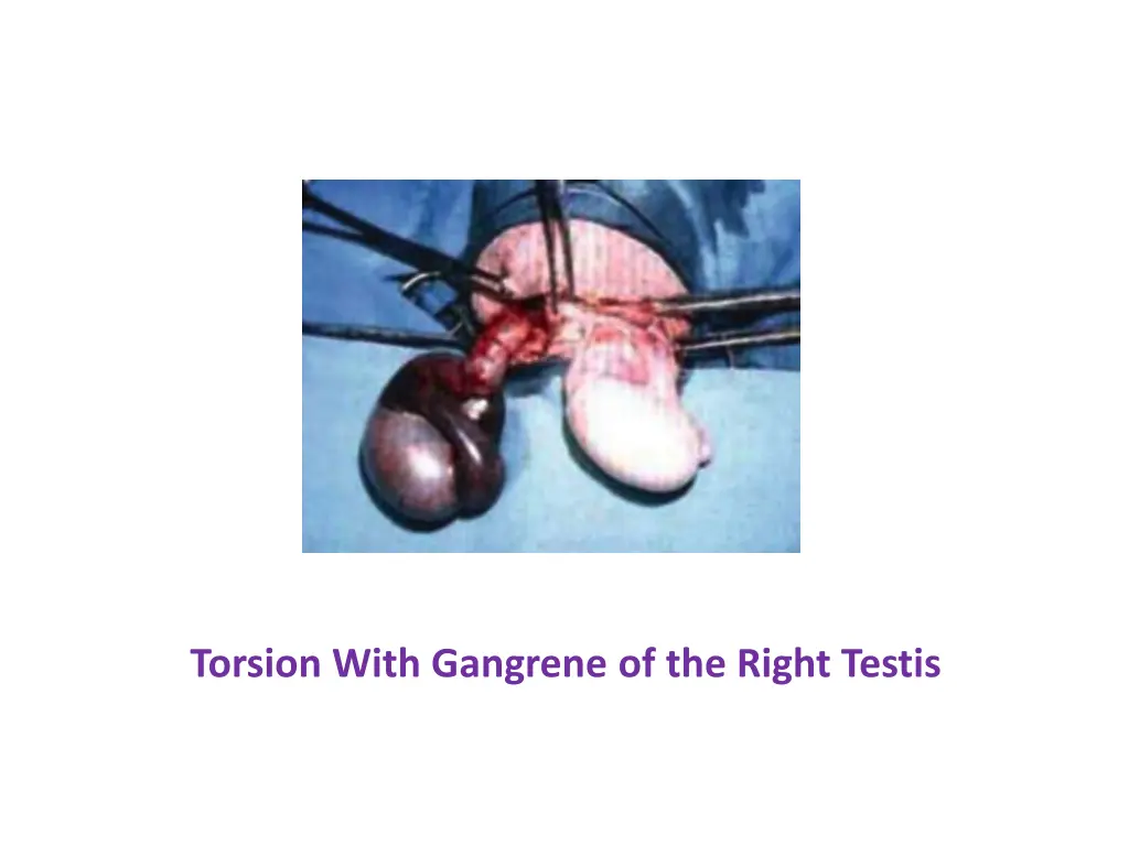 torsion with gangrene of the right testis