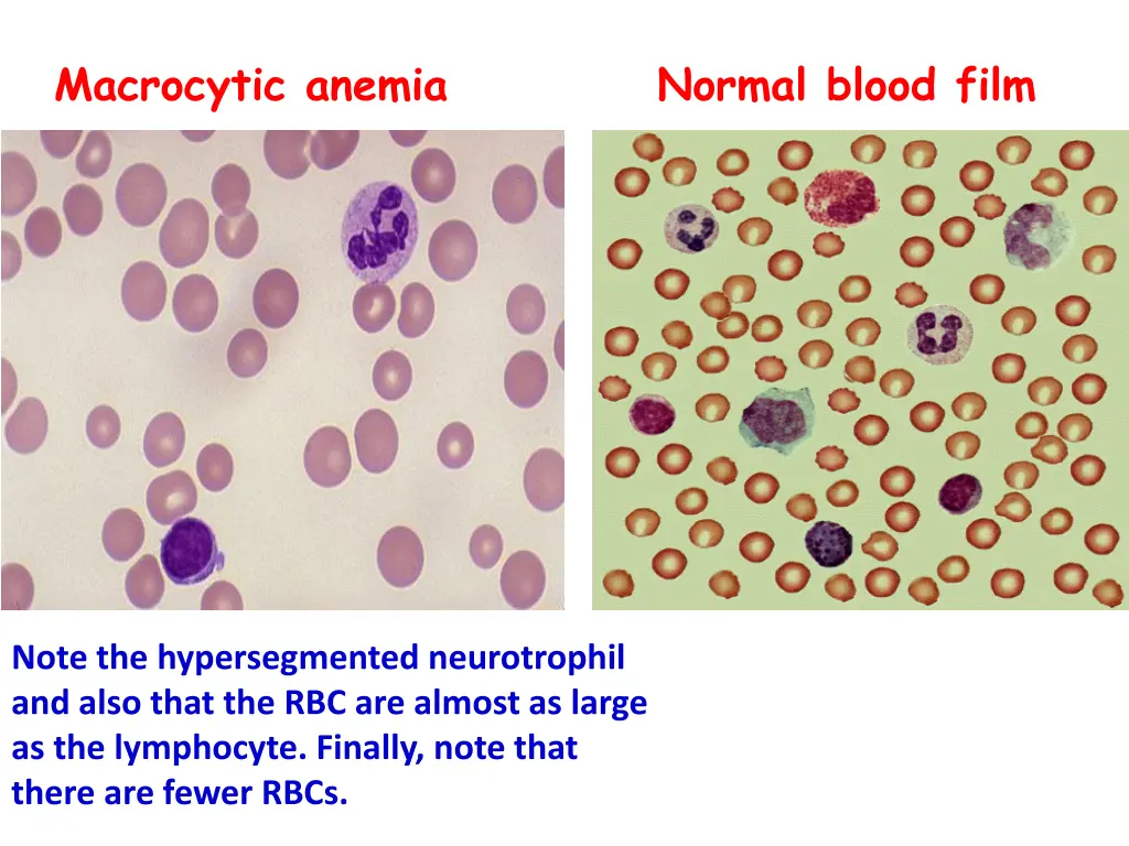 macrocytic anemia