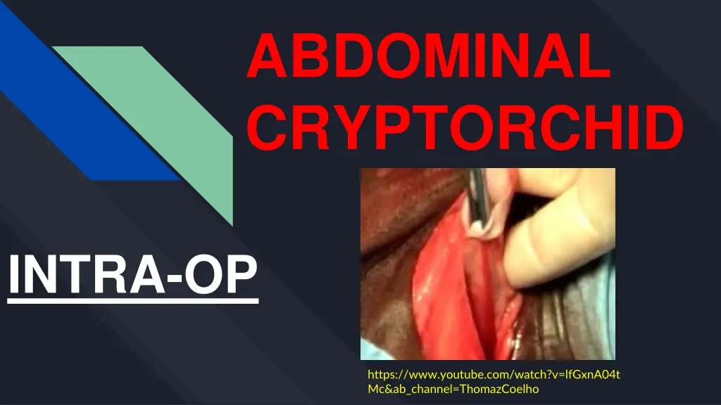 abdominal cryptorchid