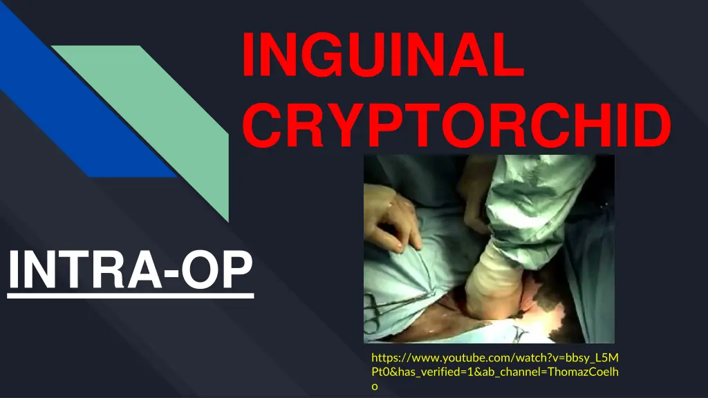 inguinal cryptorchid