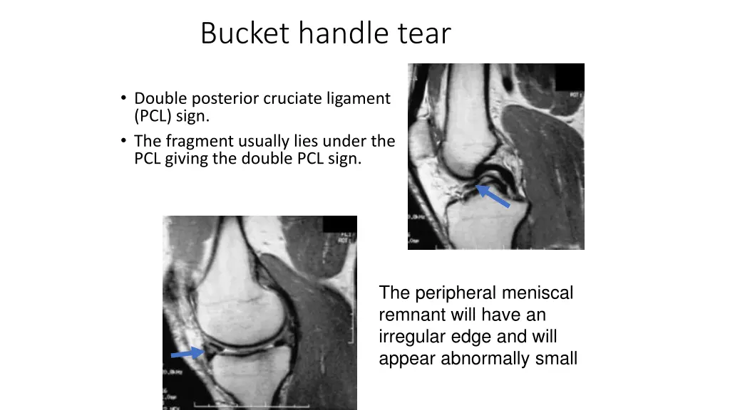 bucket handle tear
