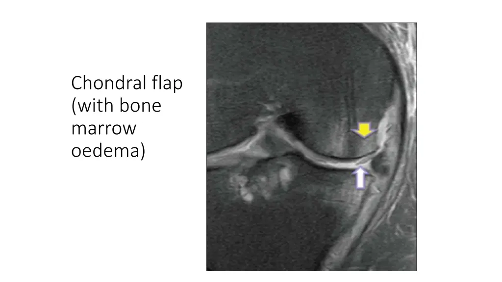 chondral flap with bone marrow oedema