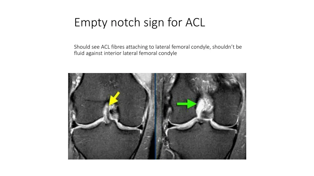 empty notch sign for acl
