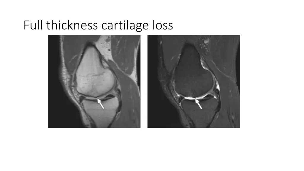 full thickness cartilage loss 1
