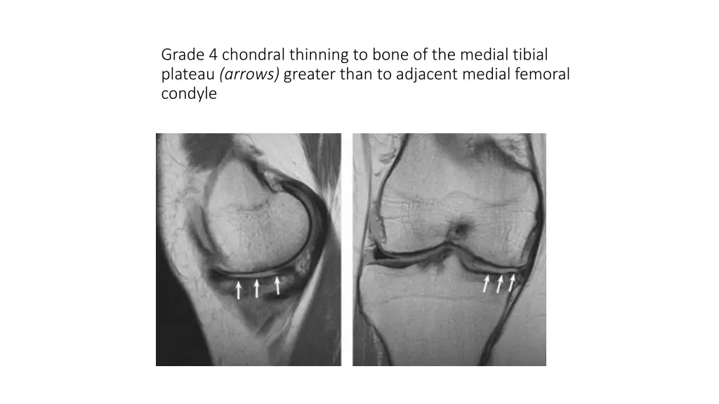 grade 4 chondral thinning to bone of the medial