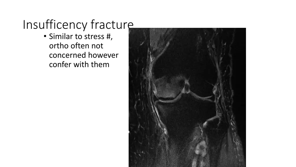 insufficency fracture similar to stress ortho