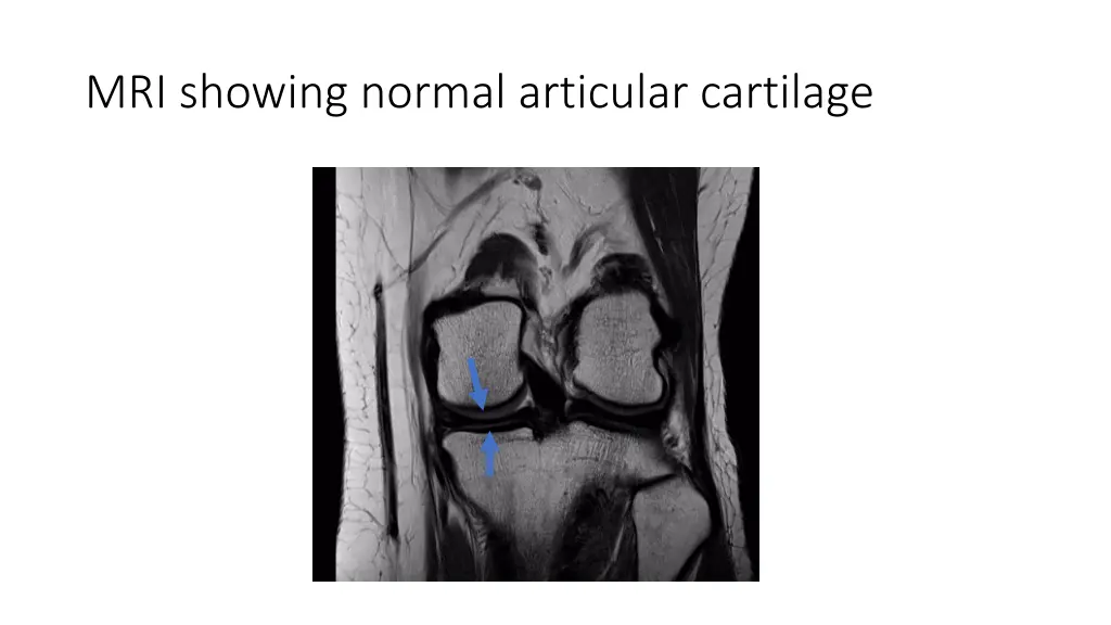 mri showing normal articular cartilage