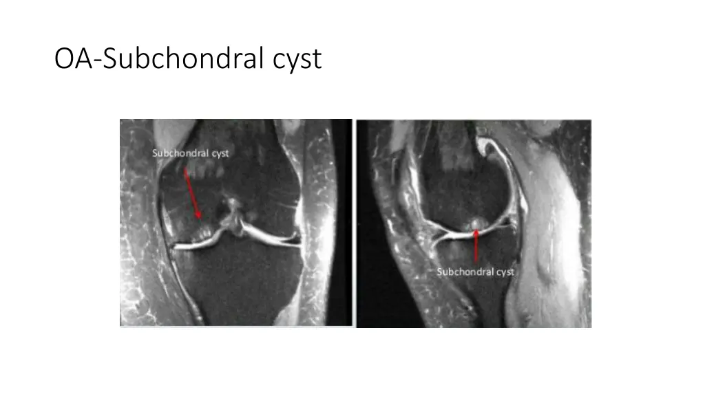 oa subchondral cyst