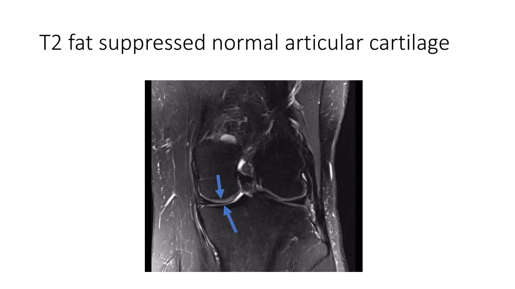 t2 fat suppressed normal articular cartilage