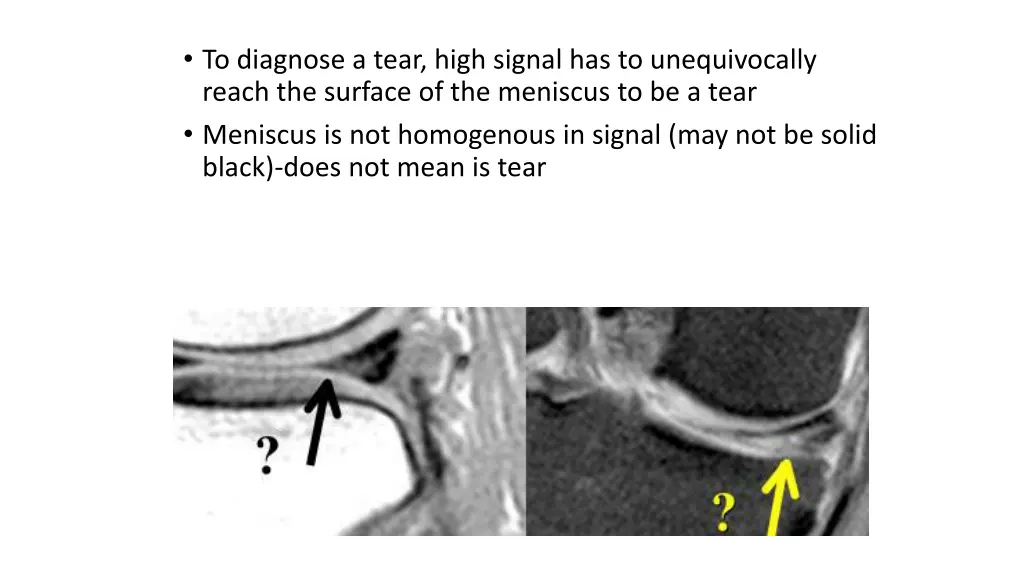 to diagnose a tear high signal