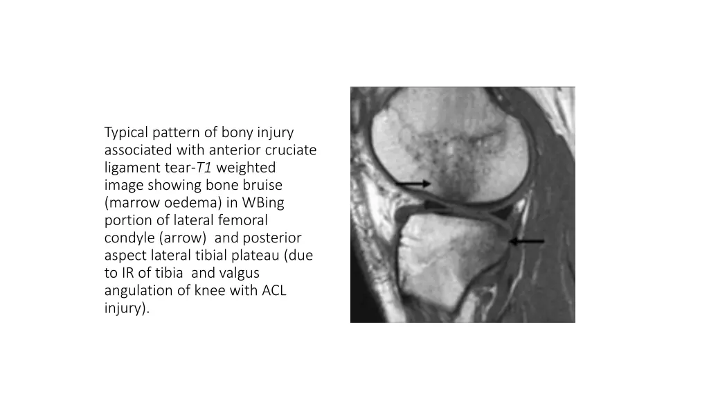 typical pattern of bony injury associated with