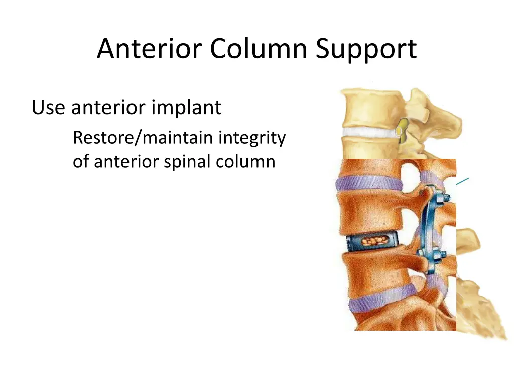 anterior column support