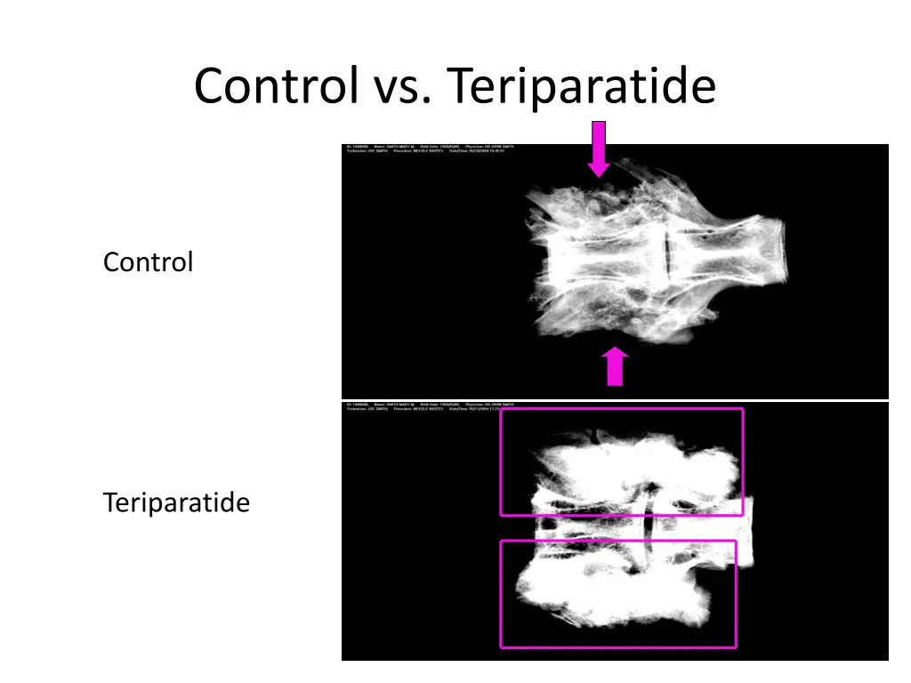 control vs teriparatide