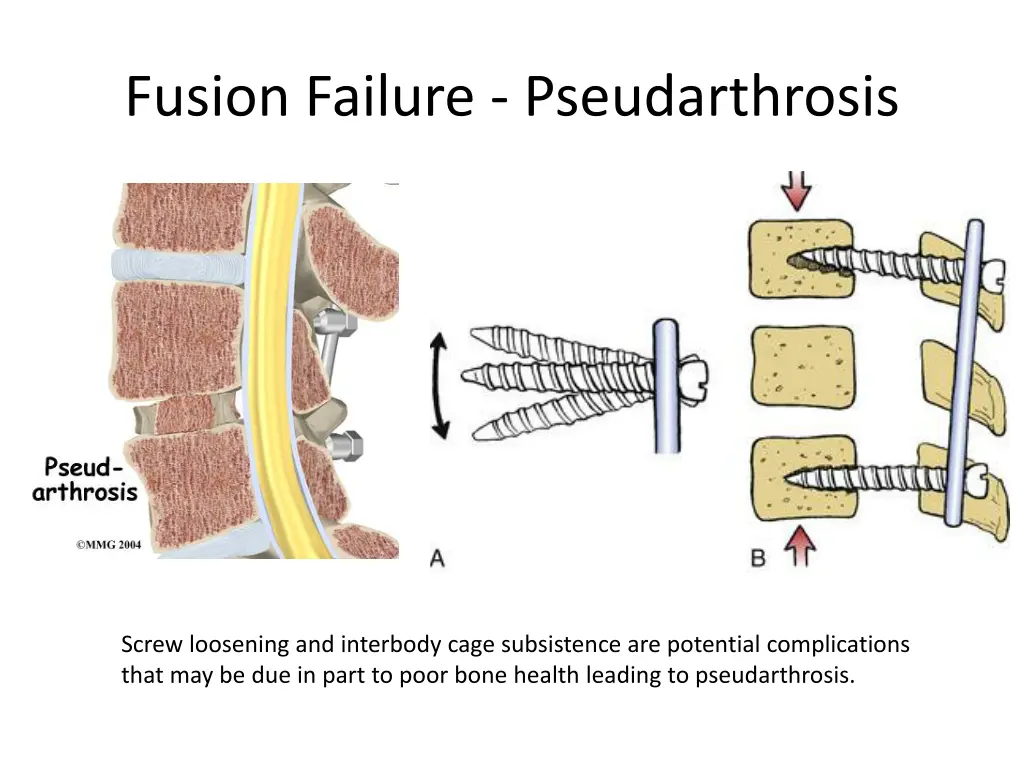 fusion failure pseudarthrosis