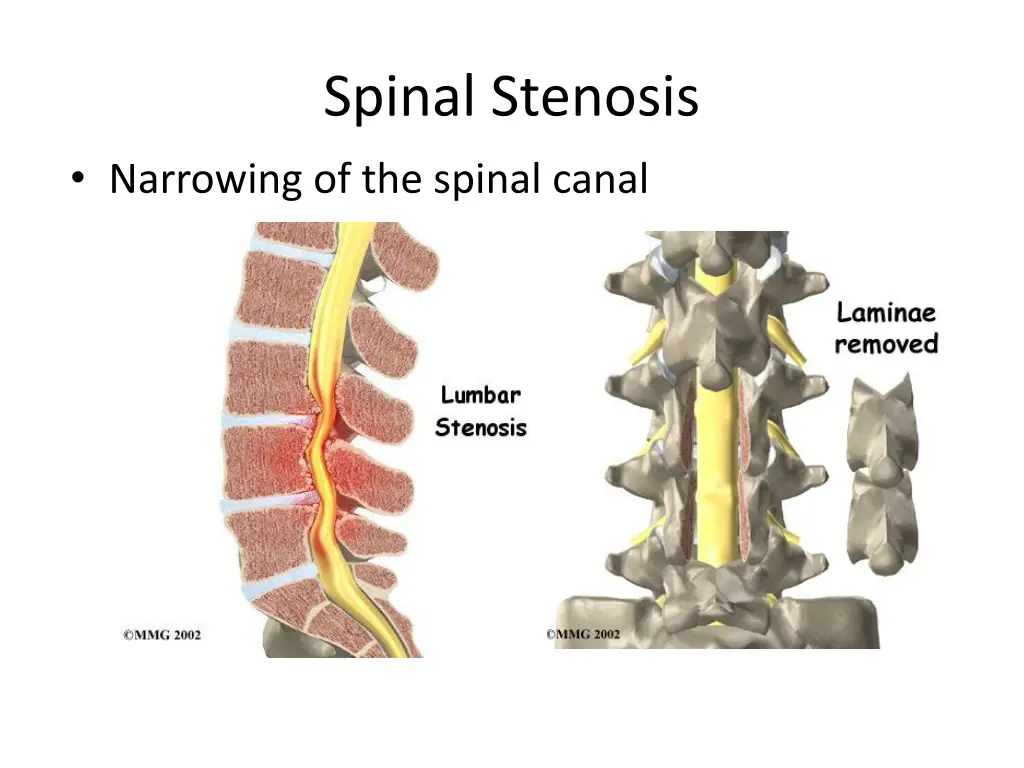 spinal stenosis