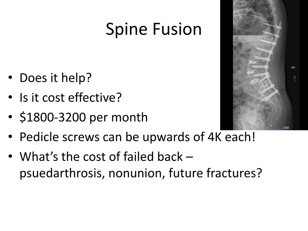 spine fusion