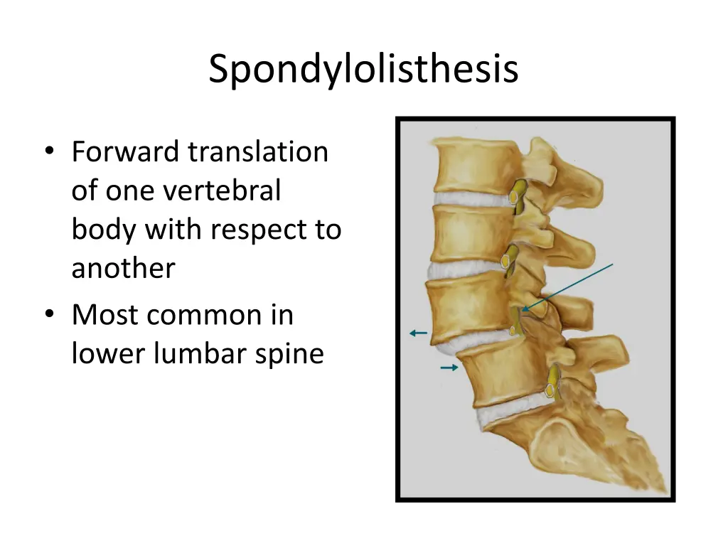 spondylolisthesis