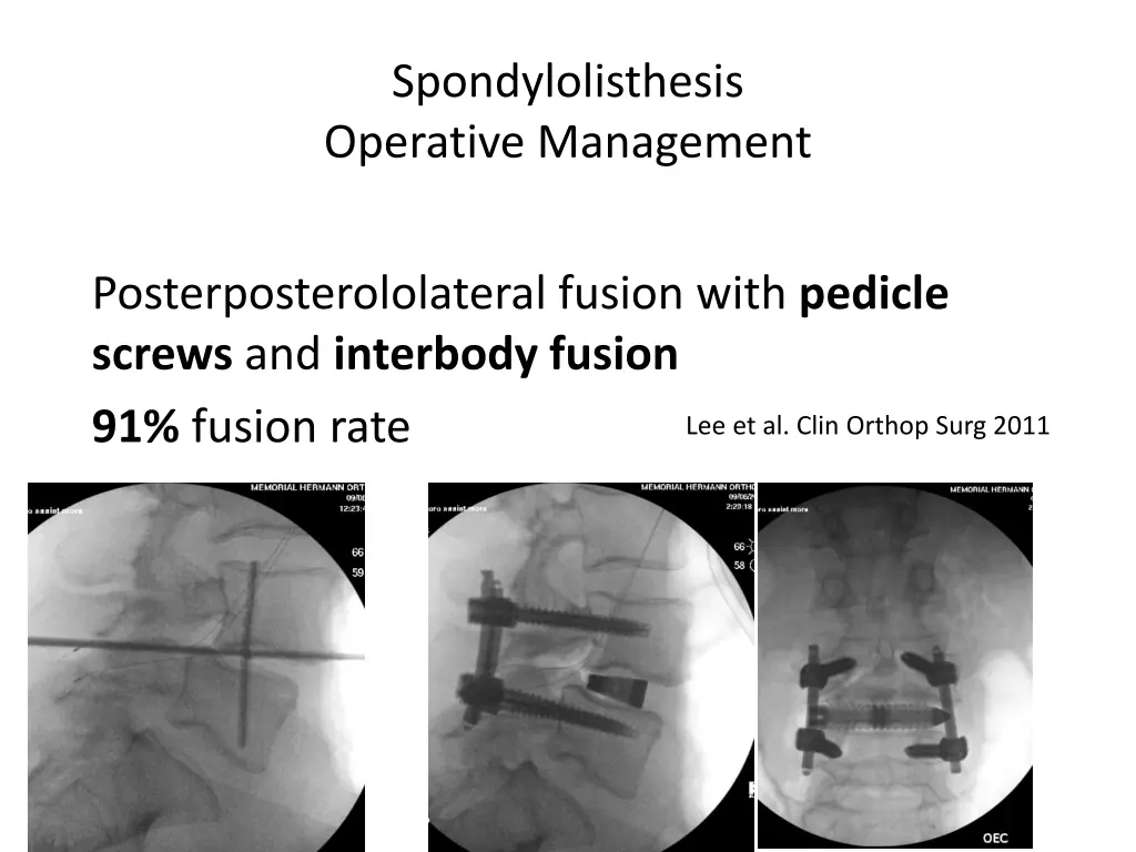 spondylolisthesis operative management 2