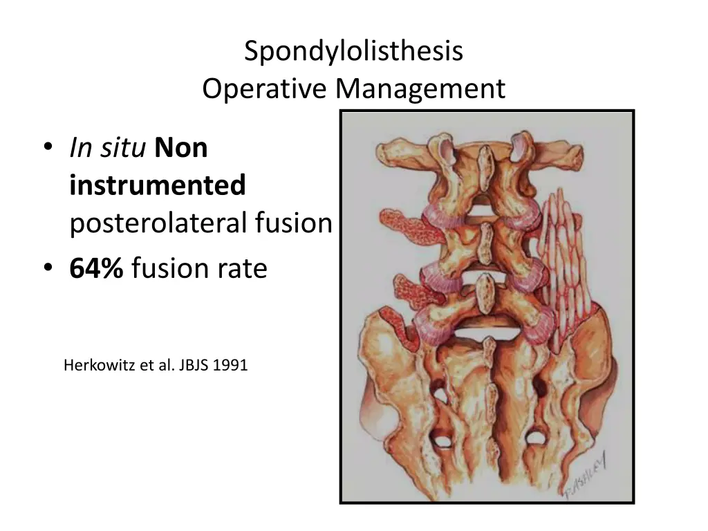 spondylolisthesis operative management