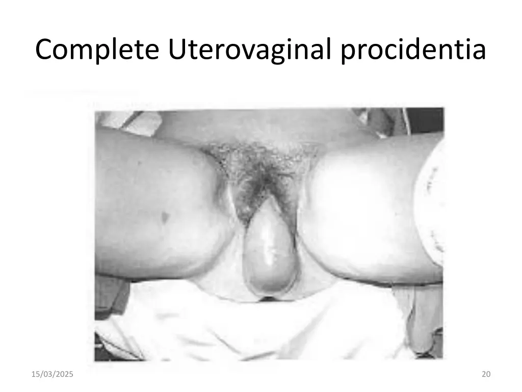 complete uterovaginal procidentia