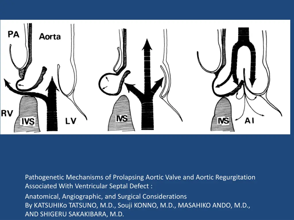 pathogenetic mechanisms of prolapsing aortic