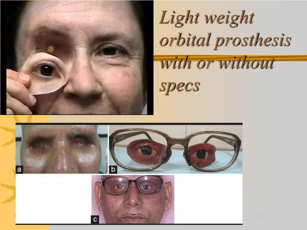 light weight orbital prosthesis with or without