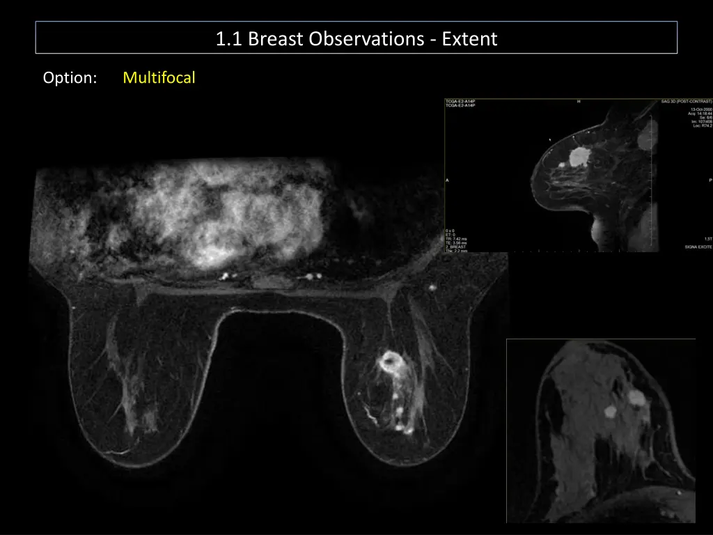 1 1 breast observations extent