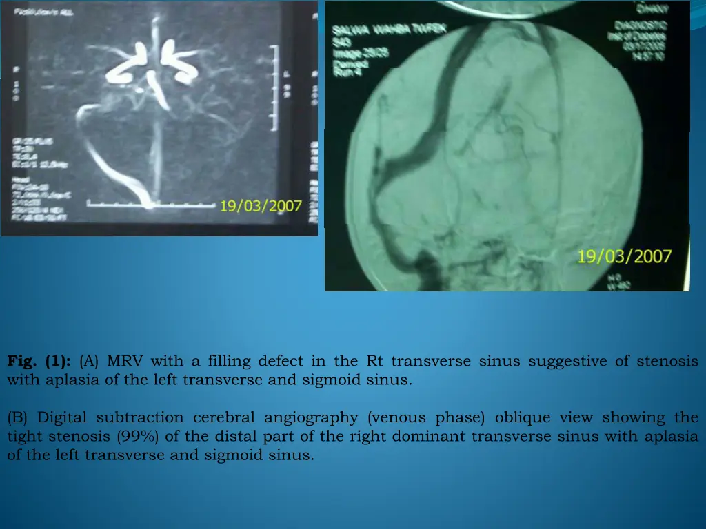 fig 1 a mrv with a filling defect