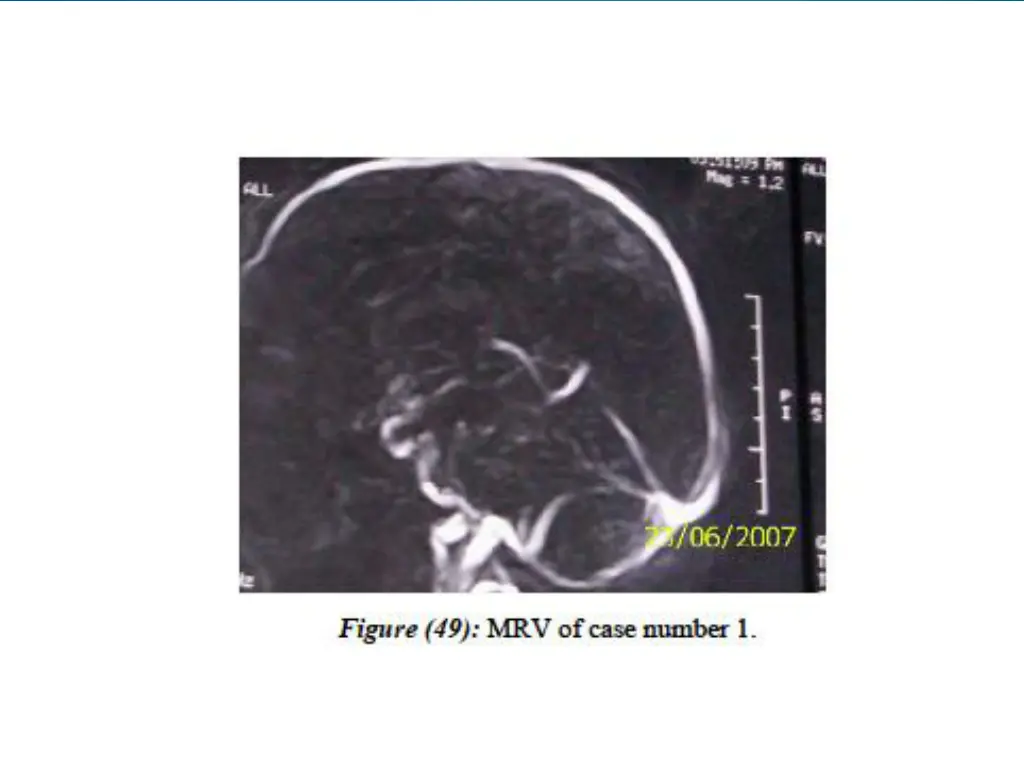 slide17