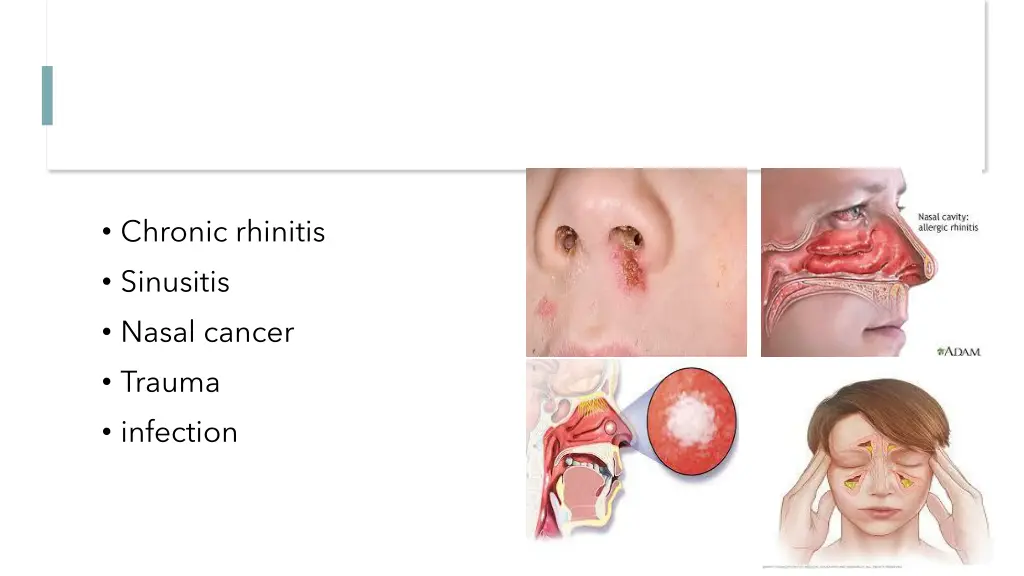 chronic rhinitis sinusitis nasal cancer trauma