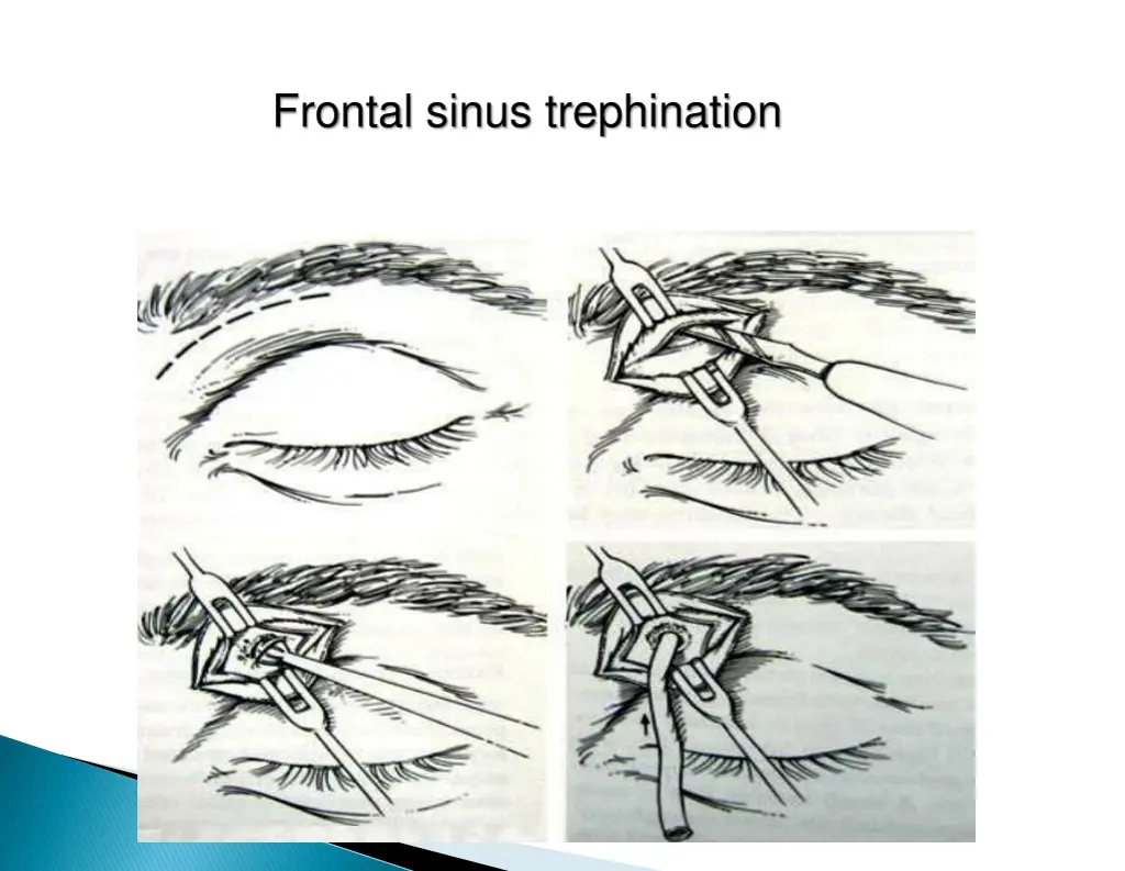 frontal sinus trephination