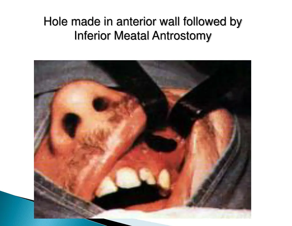 hole made in anterior wall followed by inferior