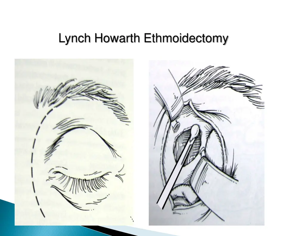 lynch howarth ethmoidectomy