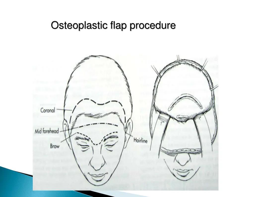 osteoplastic flap procedure