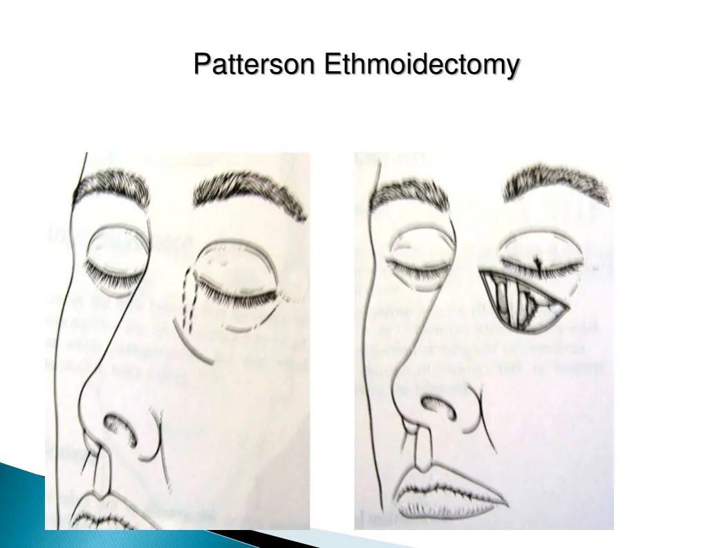 patterson ethmoidectomy