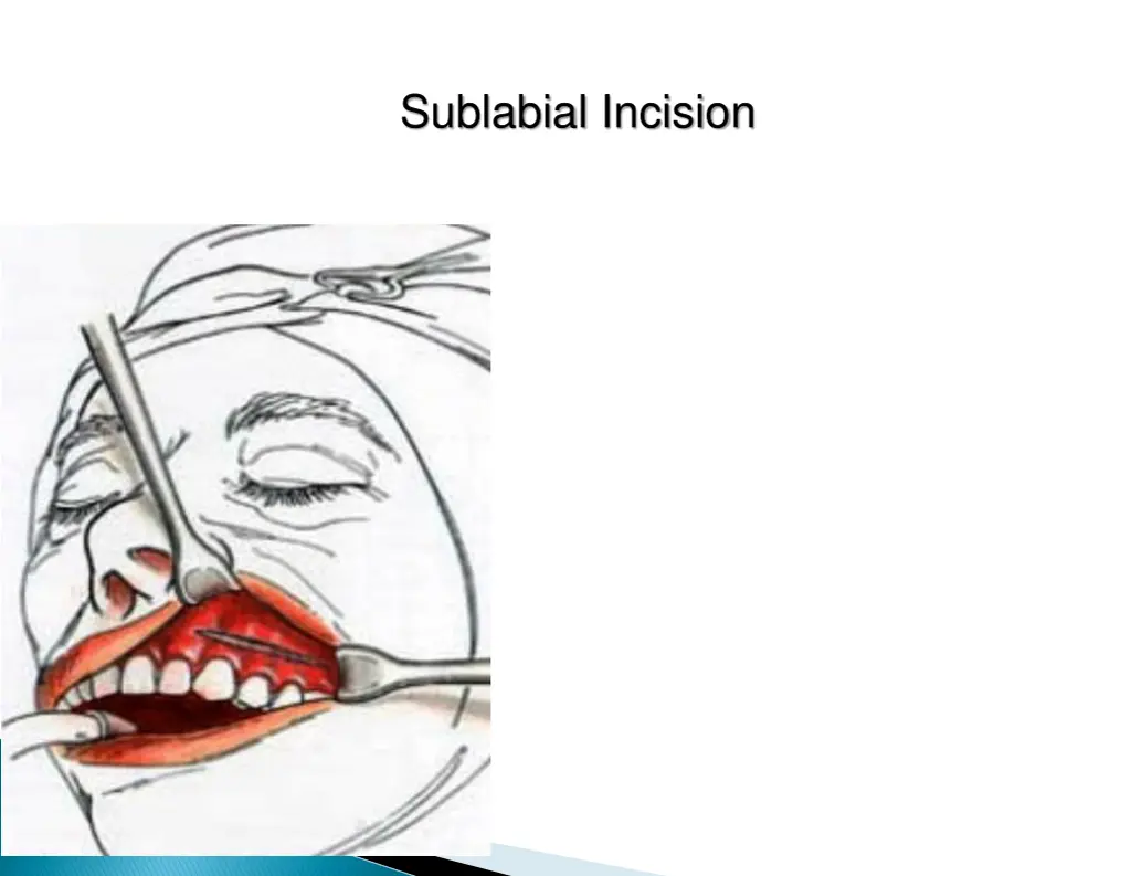 sublabial incision