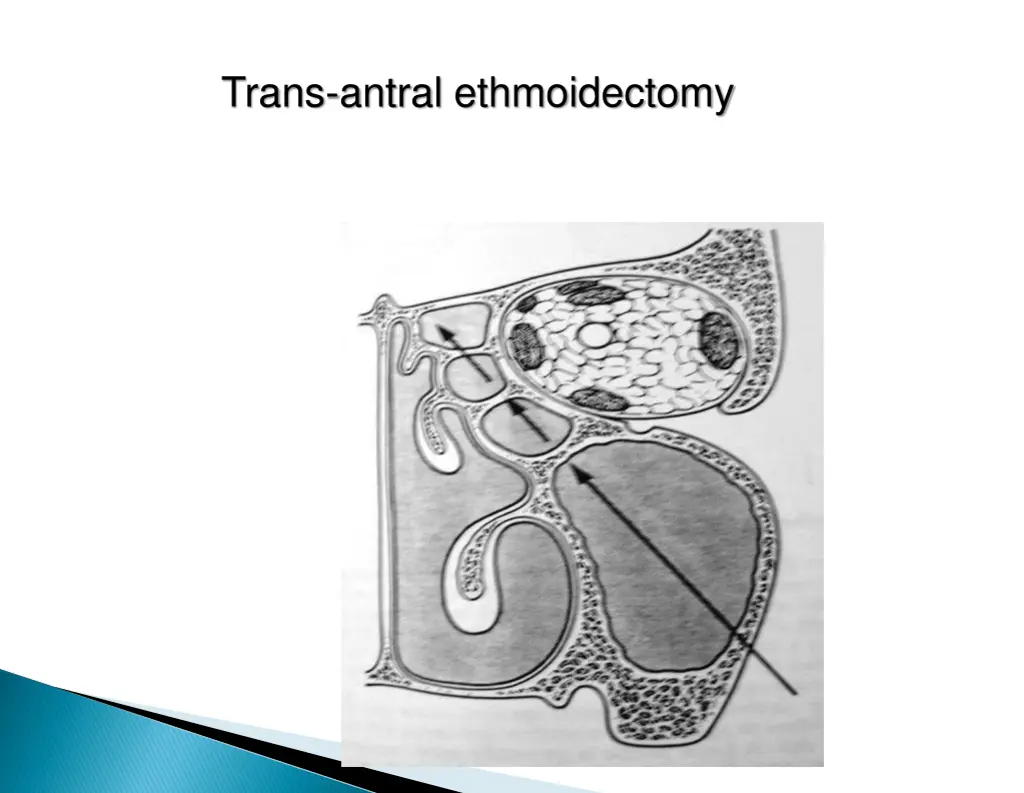 trans antral ethmoidectomy