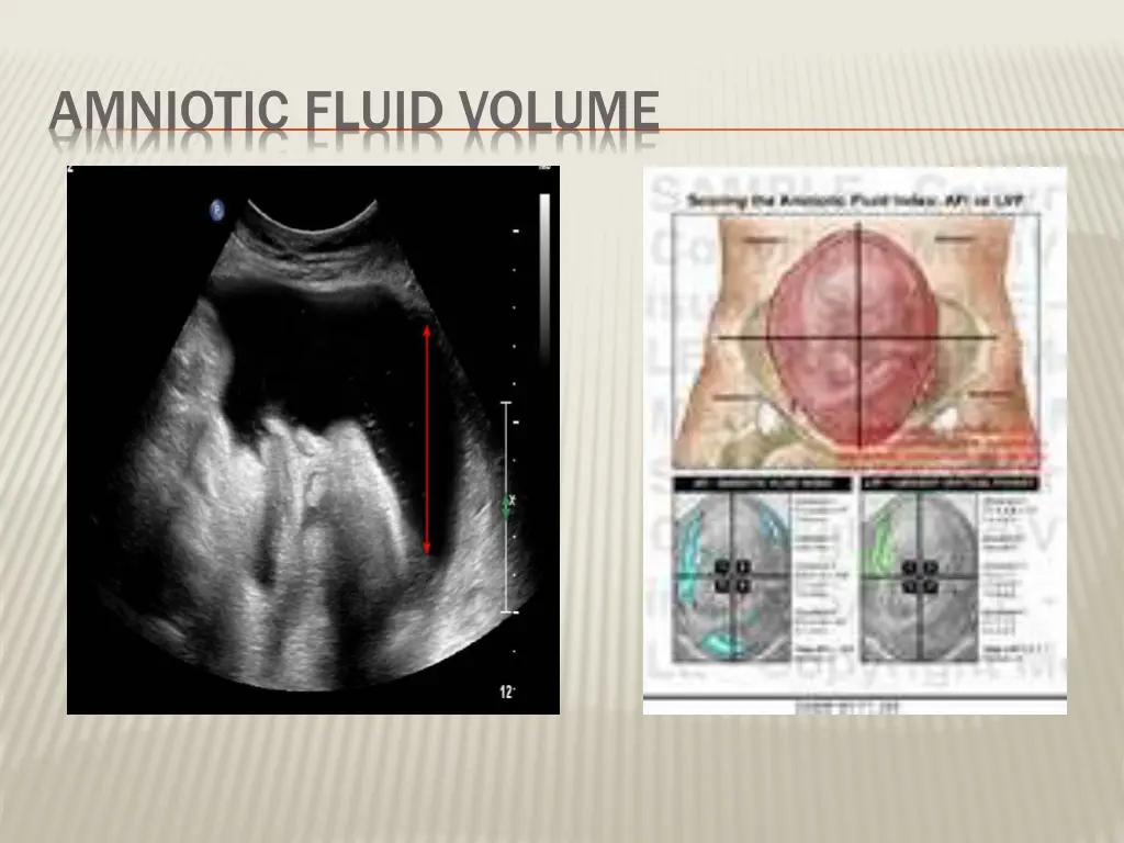 amniotic fluid volume