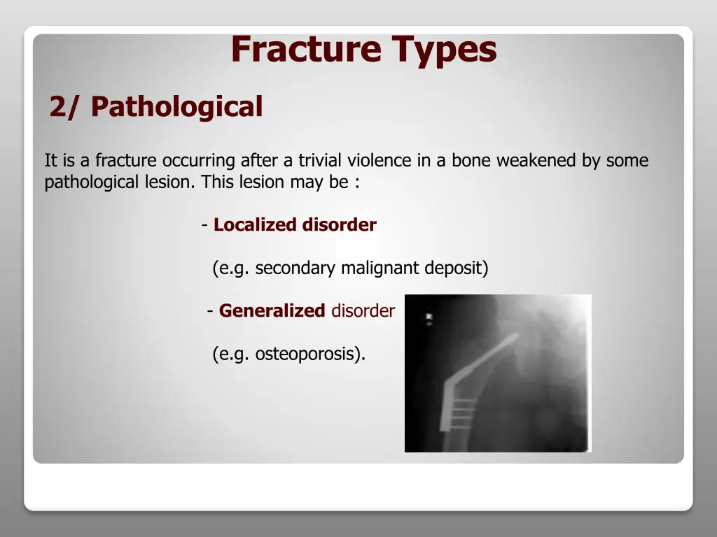 fracture types 1