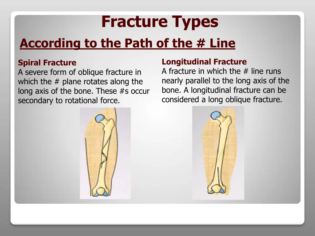 fracture types 3