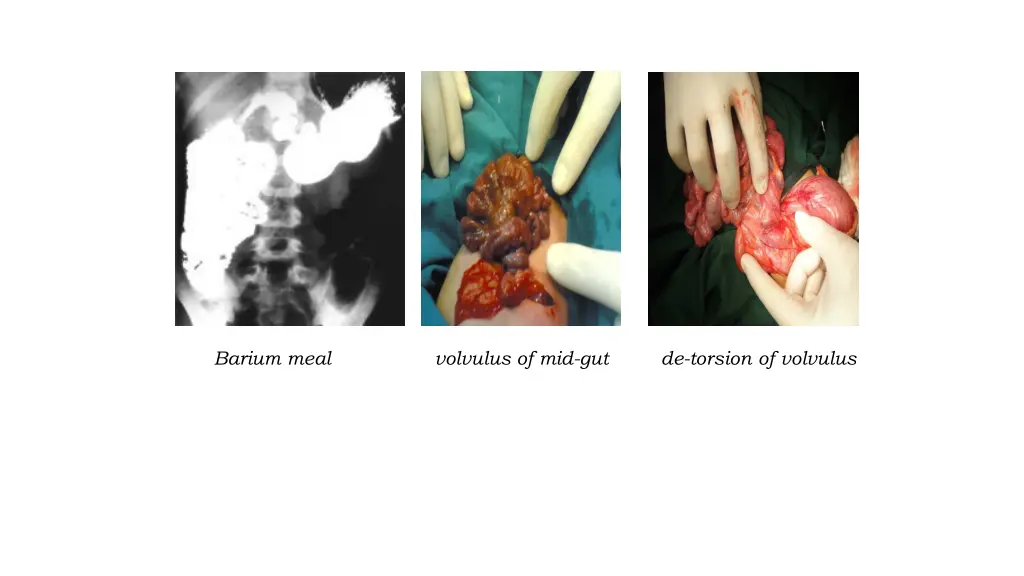 barium meal volvulus of mid gut