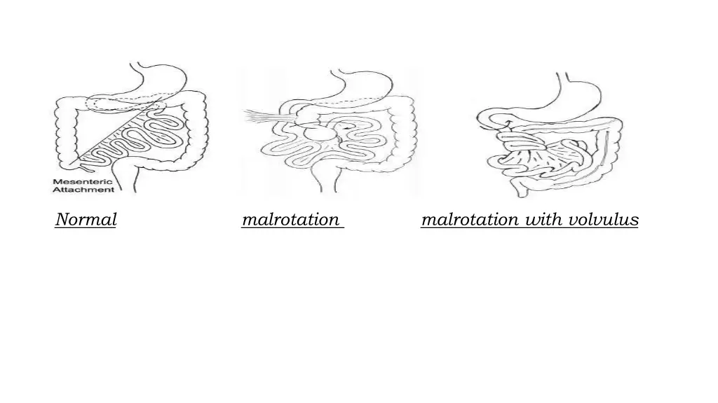 normal malrotation