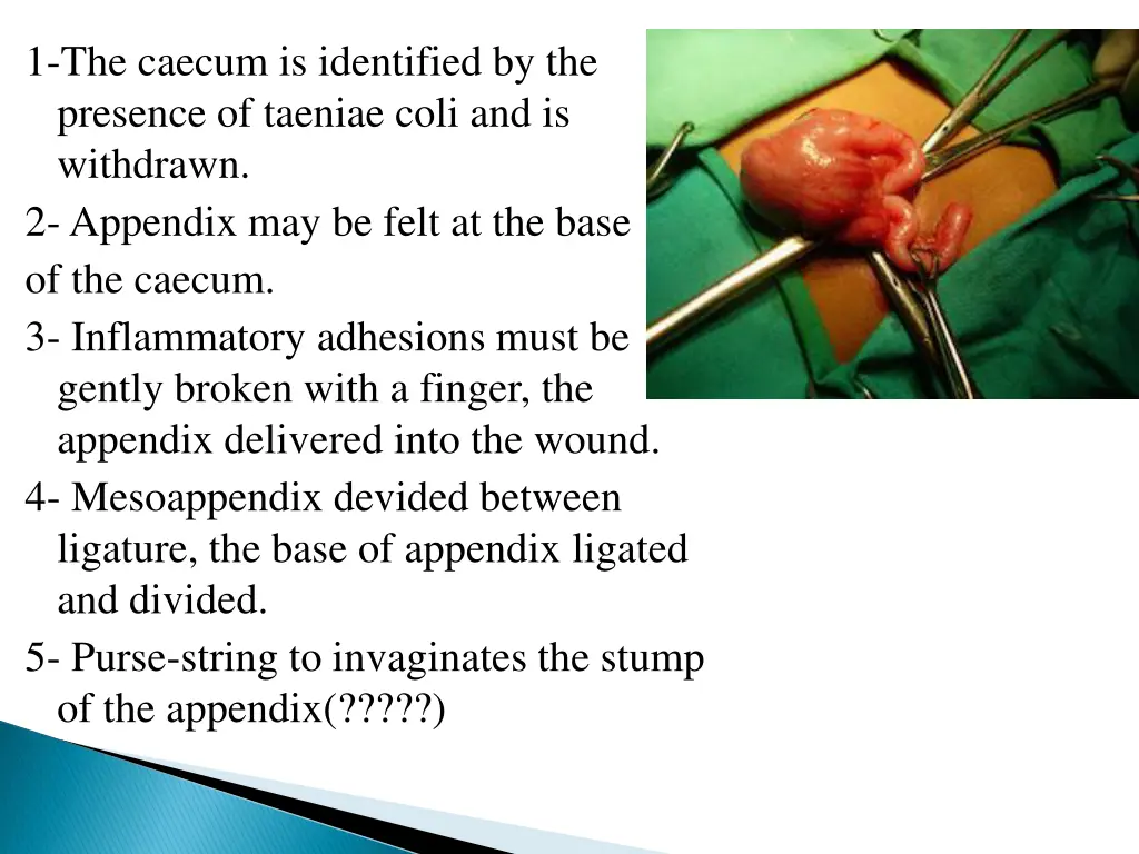 1 the caecum is identified by the presence