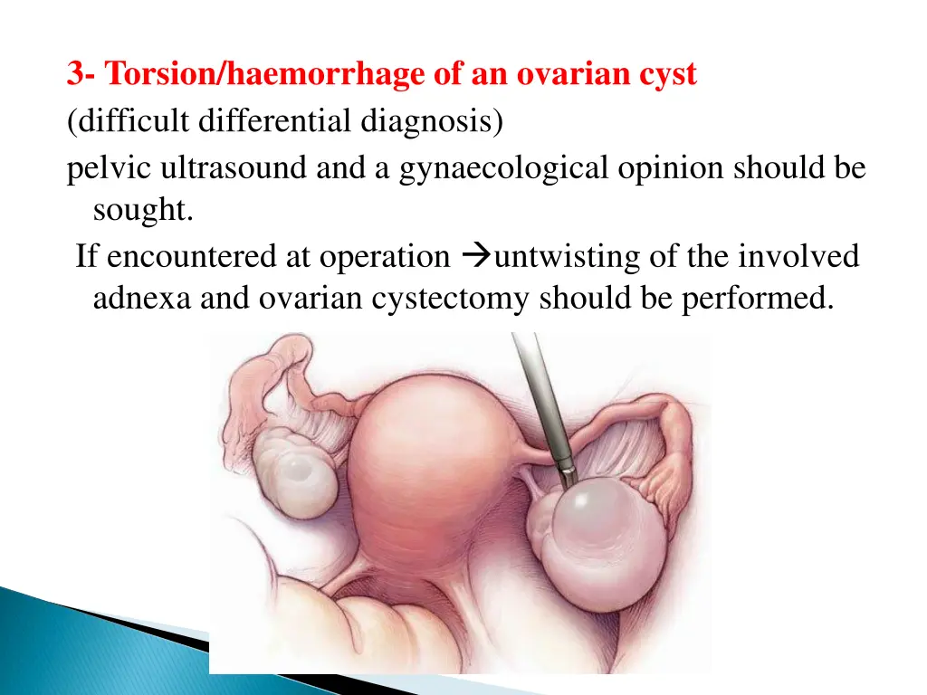 3 torsion haemorrhage of an ovarian cyst